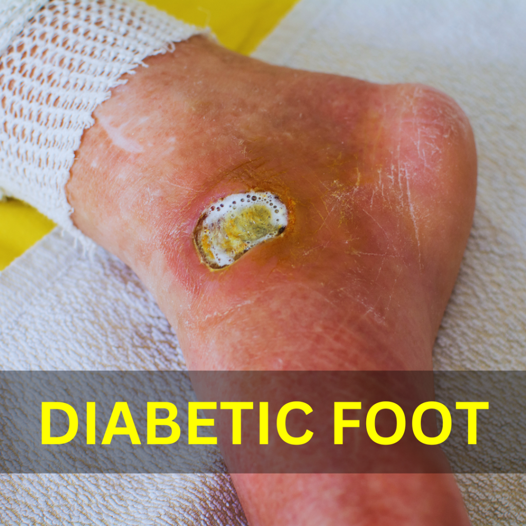 Early Stage of Dry Feet Diabetes